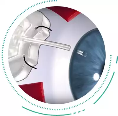 Advanced Glaucoma Valve Surgery