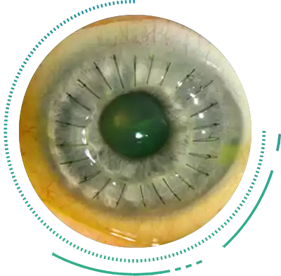 Keratoplasty Lamellar Penetrating Keratoplasty Lamellar Penetrating Treatment