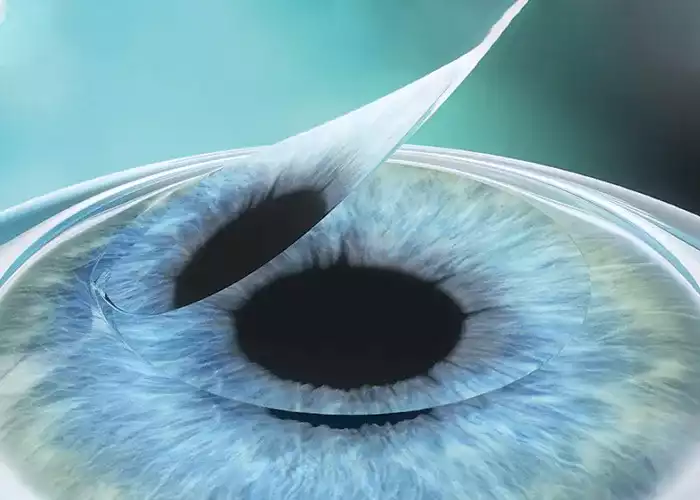 Lasik Flap Complications