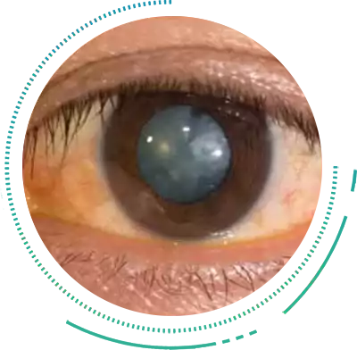 Nuclear Cataract Nuclear Cataract Eye