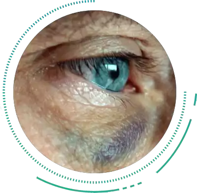 Orbital Fractures Orbital Breakage Fractures