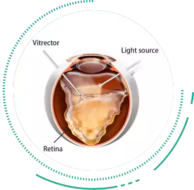 Pars Planar Vitrectomy Treatment