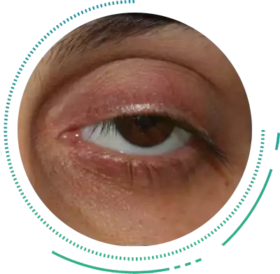 Ptosis Ptosis Eye Condition