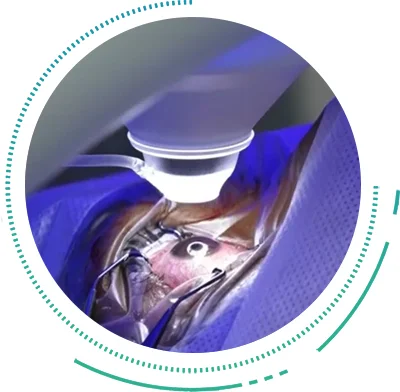Relex Smile Surgery Relex Smile Suction