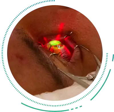 Riboflavin Corneal Cross Linking Riboflavin Corneal Collagen Cross Linking Treatment