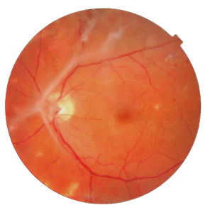 Vitrectomy Vitrectomy Retinal Detachment Surgery