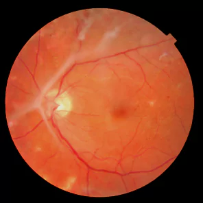 Diabetic Tractional Retinal Detachment