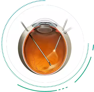 Vitrectomy Vitrectomy Treatment